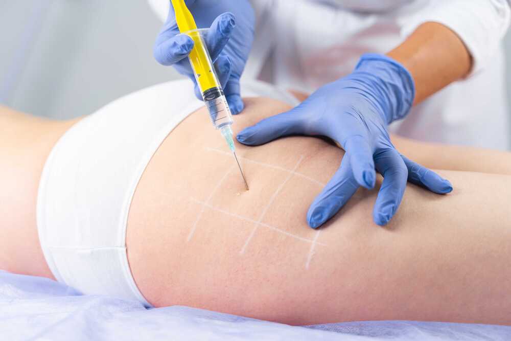 QWO Is the First FDA-Approved Injectable Treatment for Cellulite