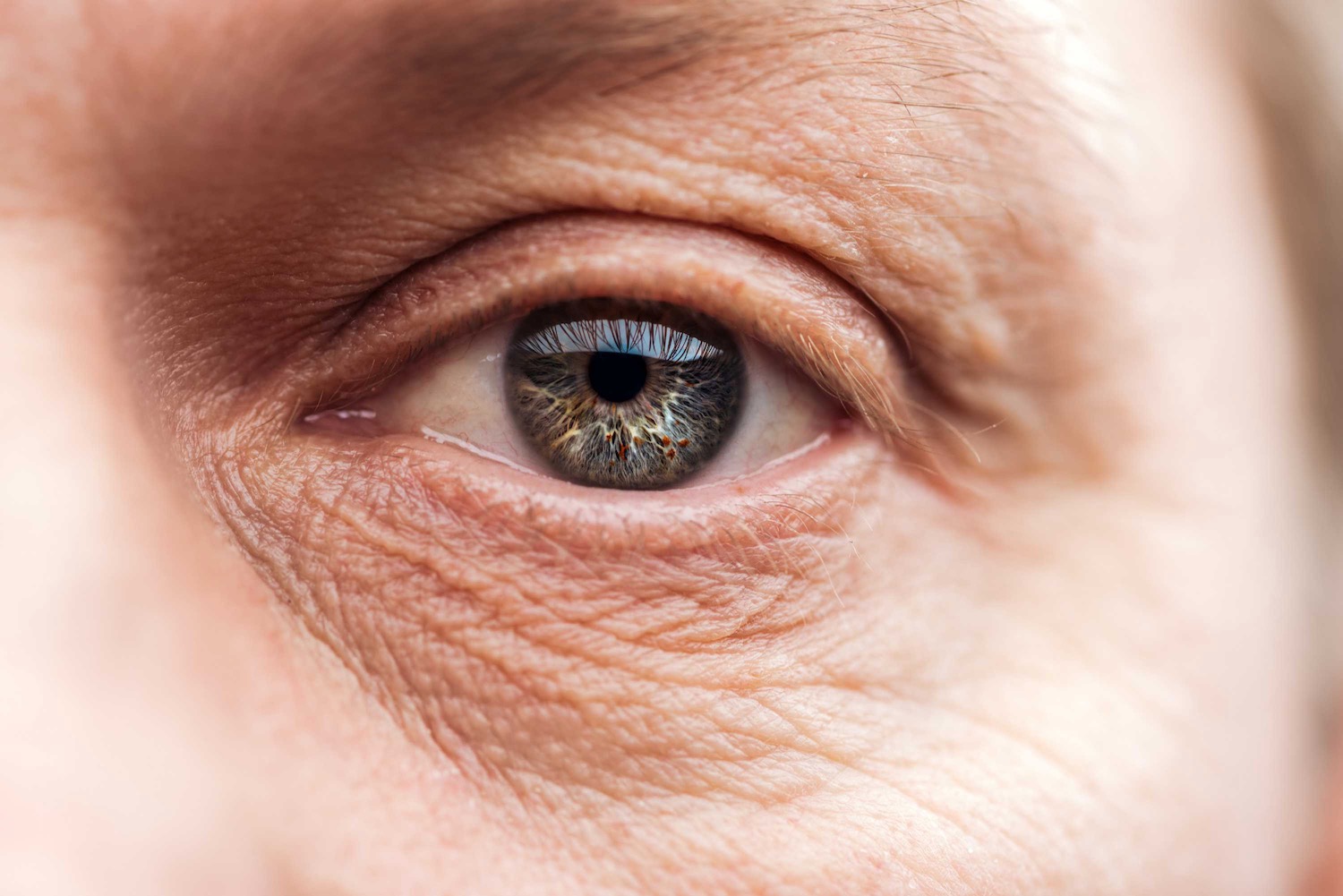 Botox for Wrinkles Under Eyes